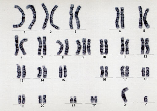 Karyotype Pictures Of Spina Bifida 95