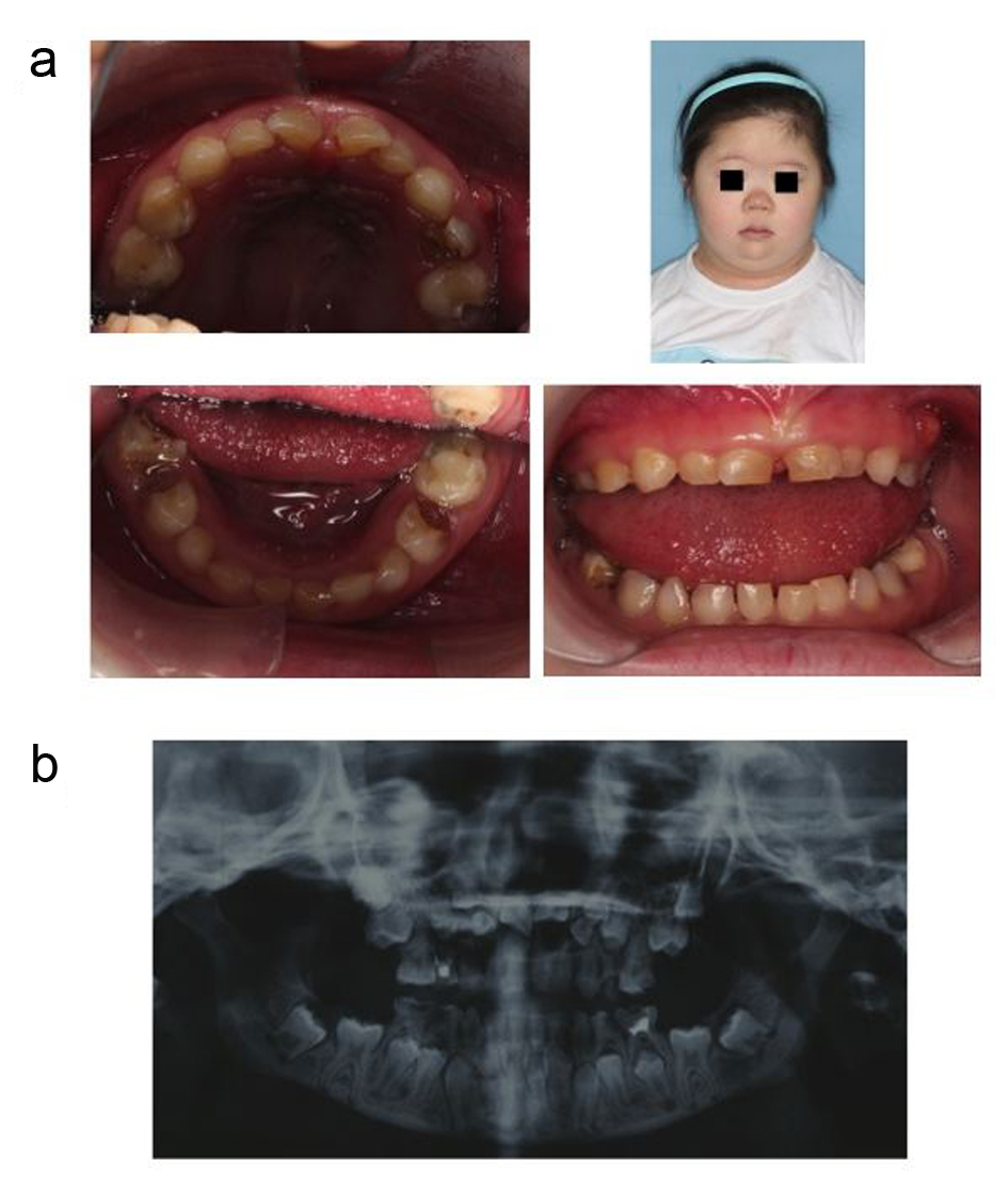 causes delayed eruption teeth infants