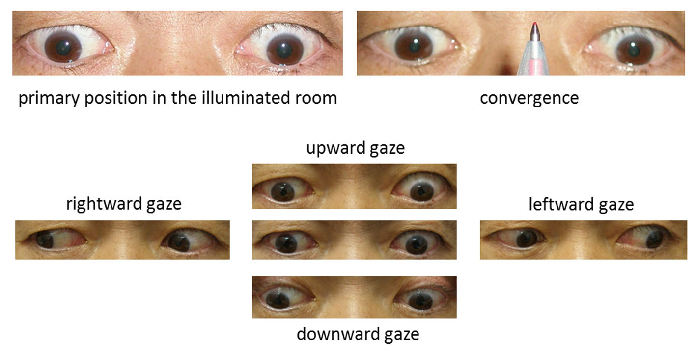 Ocular tilt reaction and skew deviation