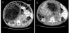 Computed Tomography Findings of a Case of Megacolon Associated with ...