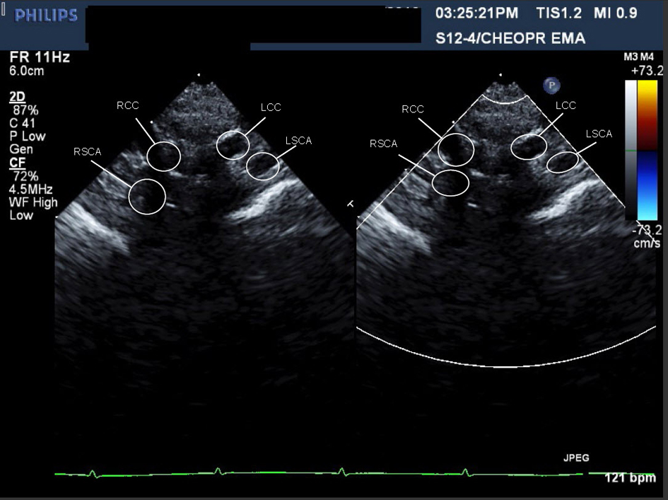 Incomplete Double Aortic Arch and Window Patent Ductus Arteriosus in a