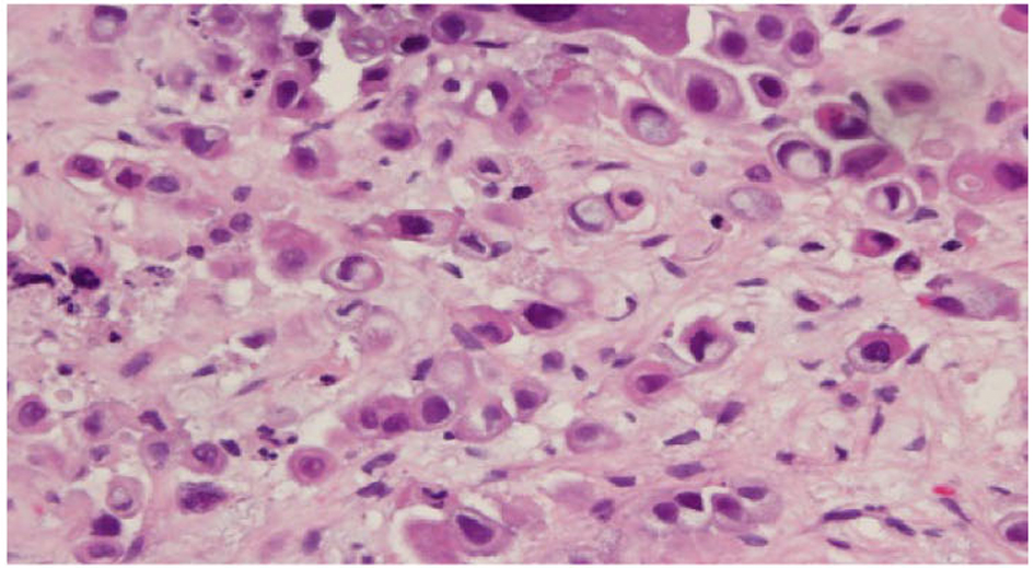 Metastatic carcinoma in the form of signet ring cells seen admixed... |  Download Scientific Diagram