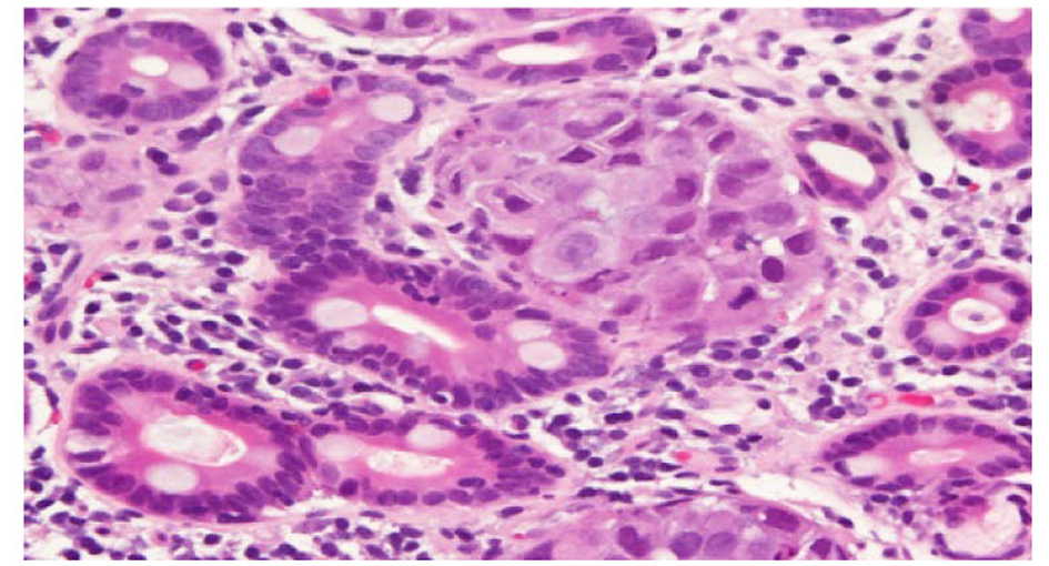 Thymic carcinoma: review and update