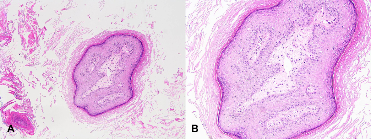 Papilloma nazális előcsarnok kezelés | PapiSTOP, Orr előcsarnok papilloma