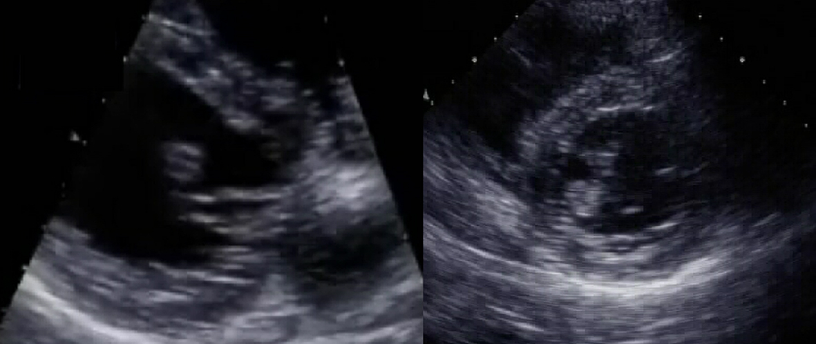 Simultaneous Thrombosis in a Normal Left Ventricle and Normal Carotid Artery in a Patient With a ...