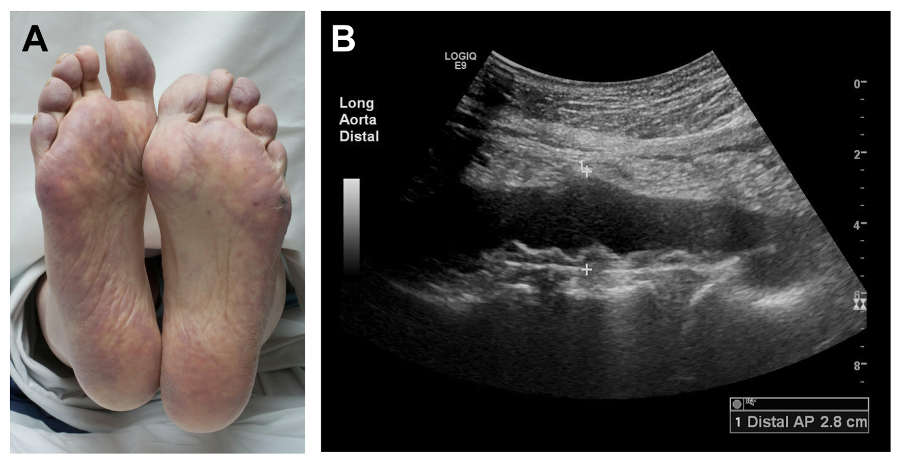 Treatment Of Cholesterol Embolization Syndrome In The Setting Of An