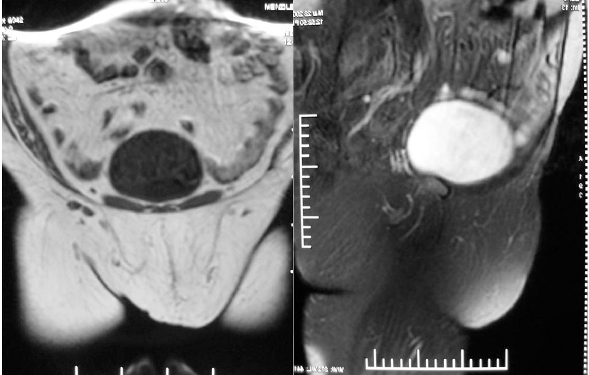 Giant Pubic Lipoma in Normal Individual, Sivrioglu