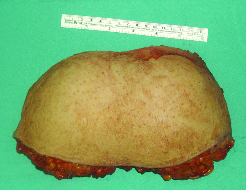 Giant Pubic Lipoma in Normal Individual, Sivrioglu