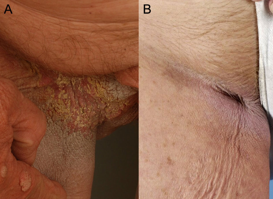 Paraneoplastic Acanthosis Nigricans, Leser-Trélat and Tripe Palms  Associated With Gastro-Esophageal Junction Adenocarcinoma: A Case Report |  Hagen | Journal of Medical Cases
