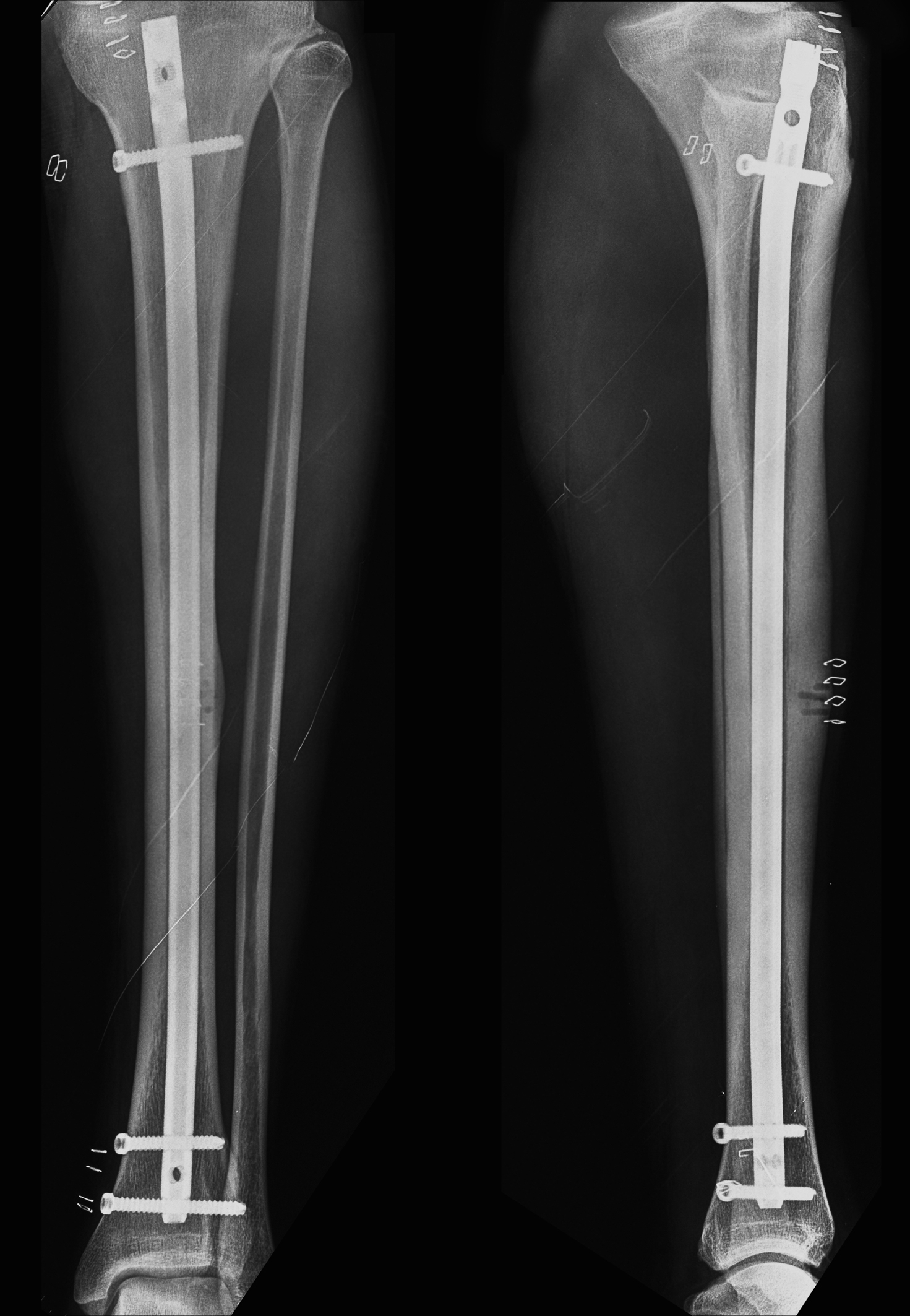 Comparative study between intramedullary interlocking nailing and minimally  invasive percutaneous plate osteosynthesis for distal tibia extra-articular  fractures | Chinese Journal of Traumatology