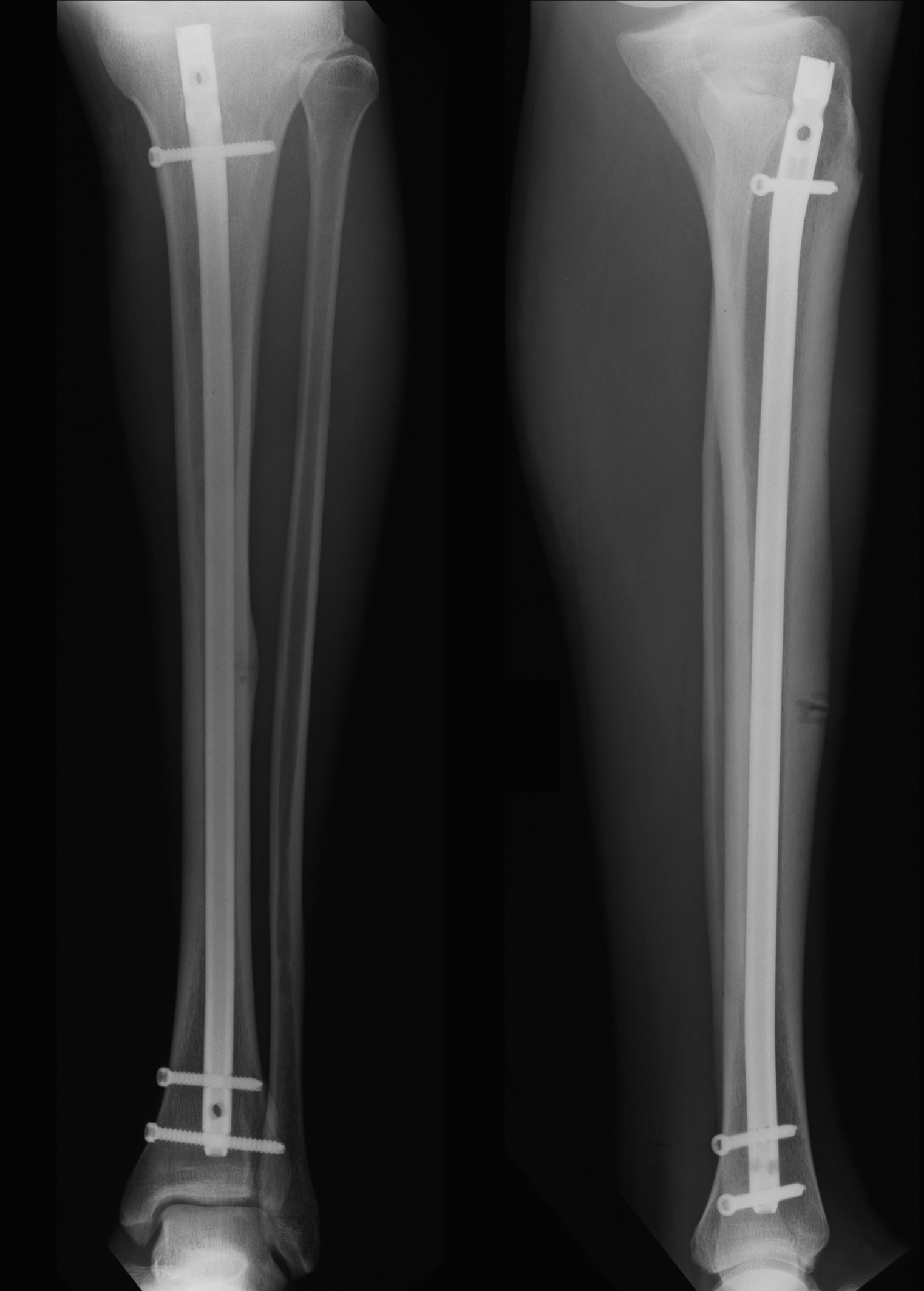 How Well Do You Know About Your Intramedullary Nail – Medical Equipment  Industry in India – Market Research, Industry Analysis & Trends