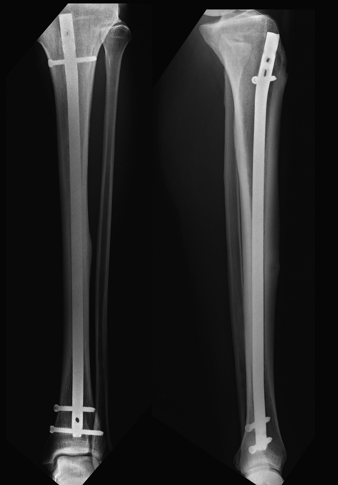 JFMK | Free Full-Text | Tibiotarsal Arthrodesis with Retrograde Intramedullary  Nail and RIA Graft: A Salvage Technique