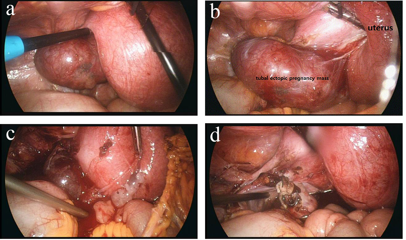 Unusually Large, Unruptured Tubal Ectopic Pregnancy Mass in a