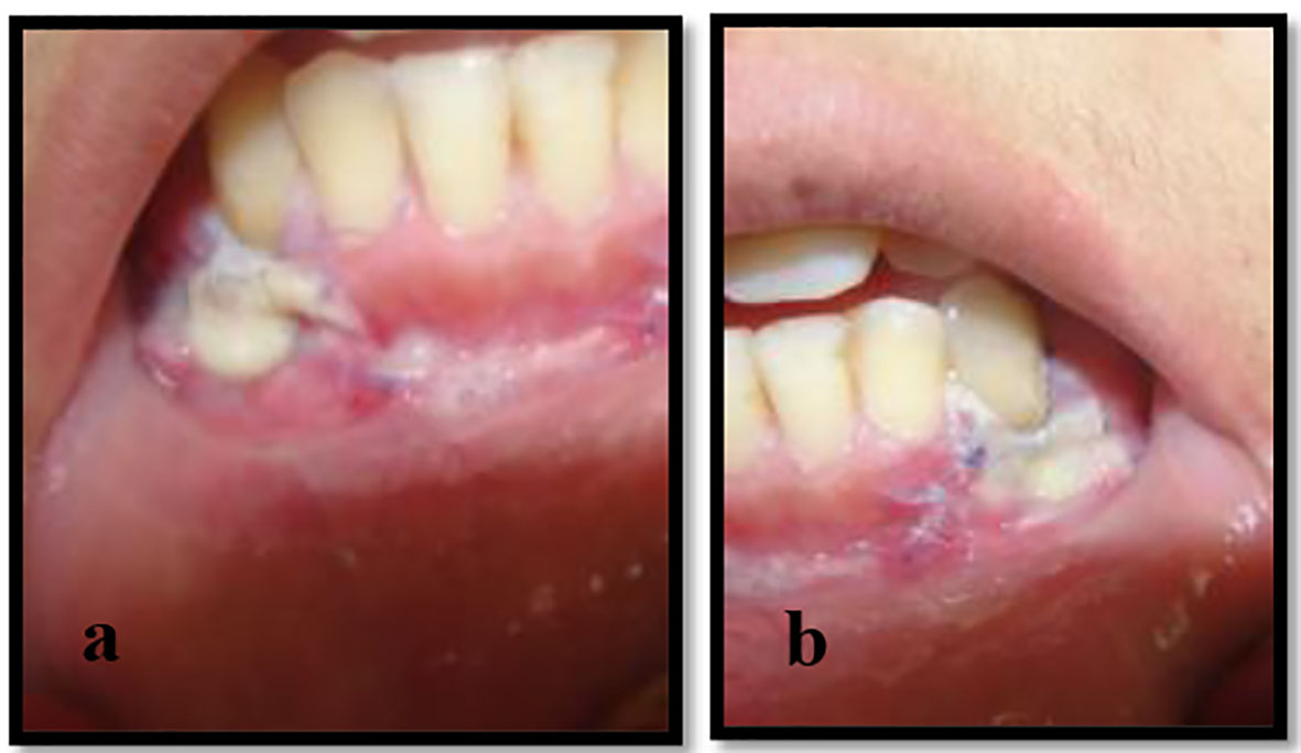 How do you know if a gum graft failed