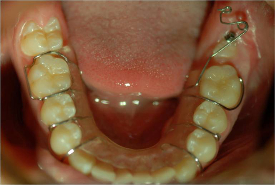 The treatment of impacted mandibular second molars using brass