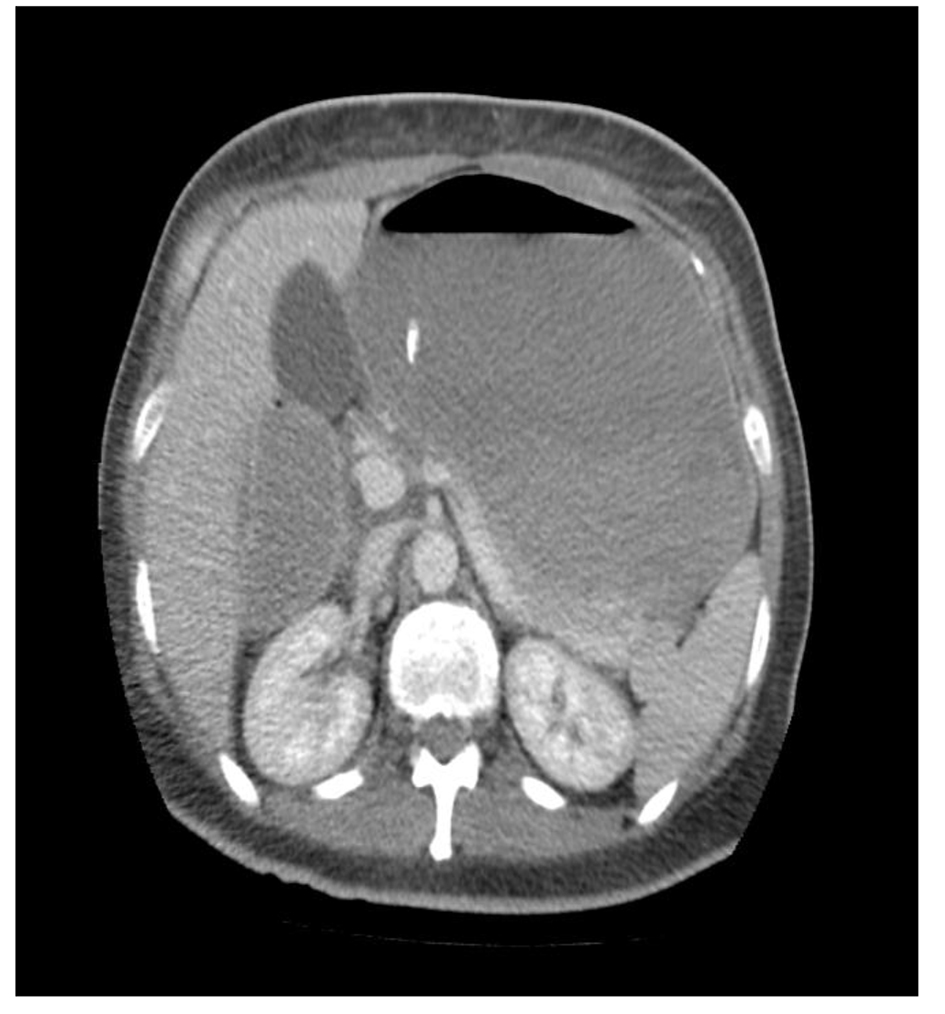 Superior Mesenteric Artery Syndrome: A High Index of Suspicion | Rahman