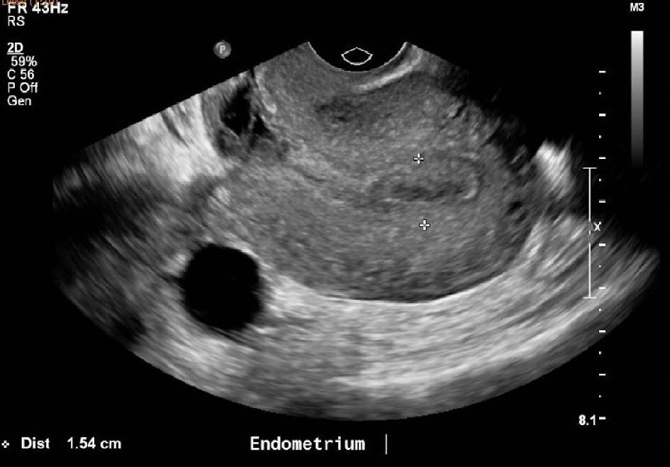 Is thickness what abnormal? endometrial 