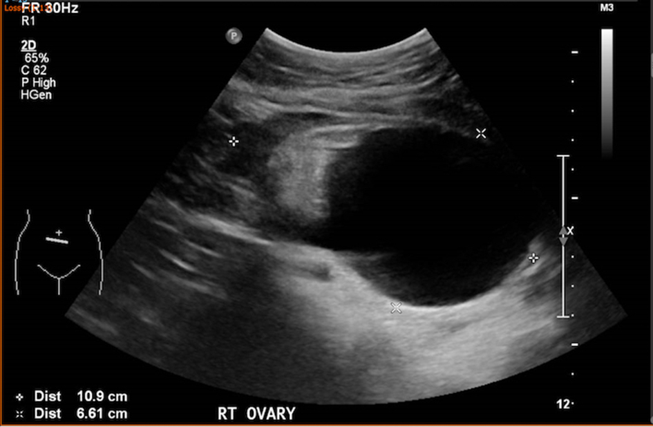 right ovarian mature cystic teratoma icd 10