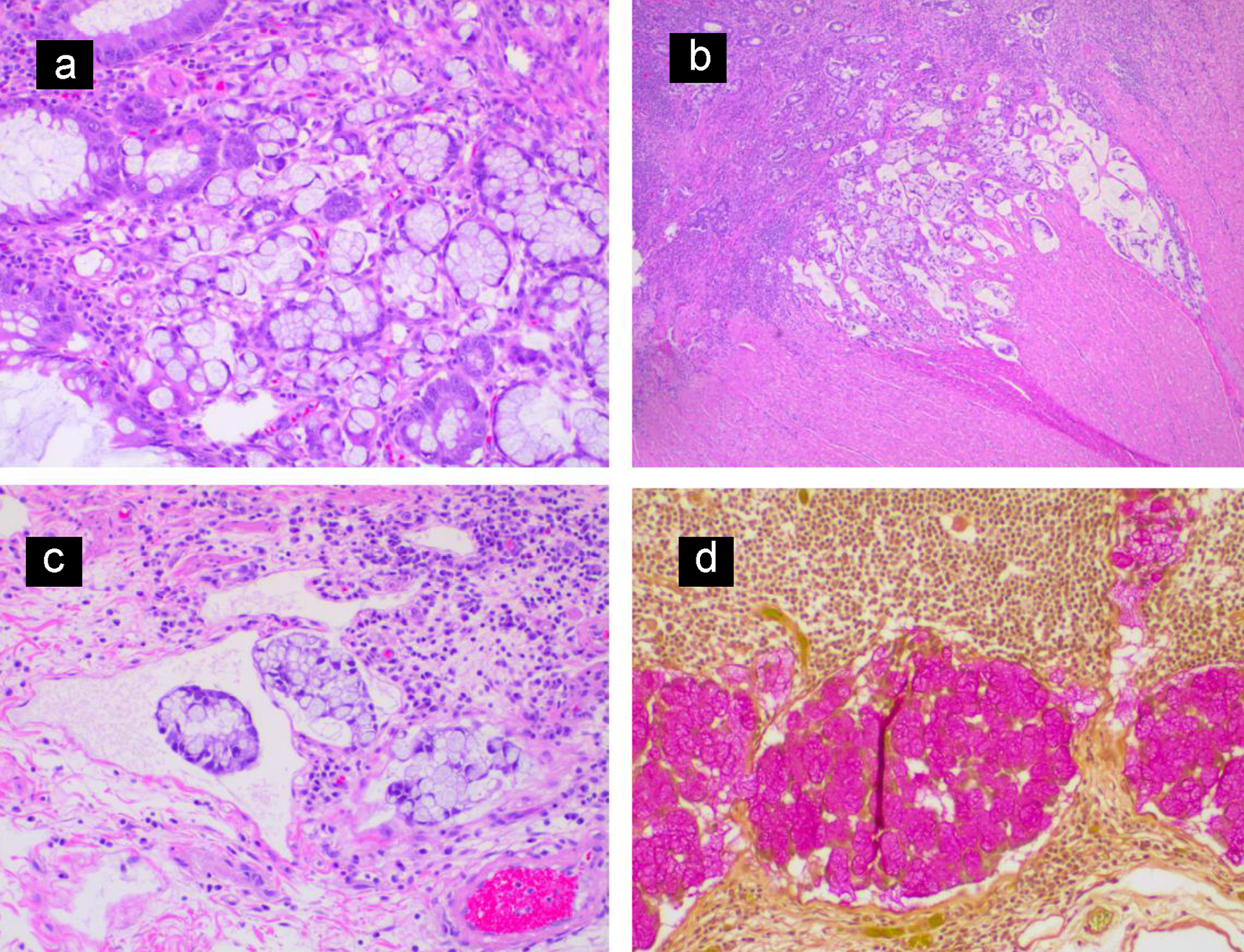 Signet-Ring Cell Carcinoma Co-Existing with Adenocarcinoma of the