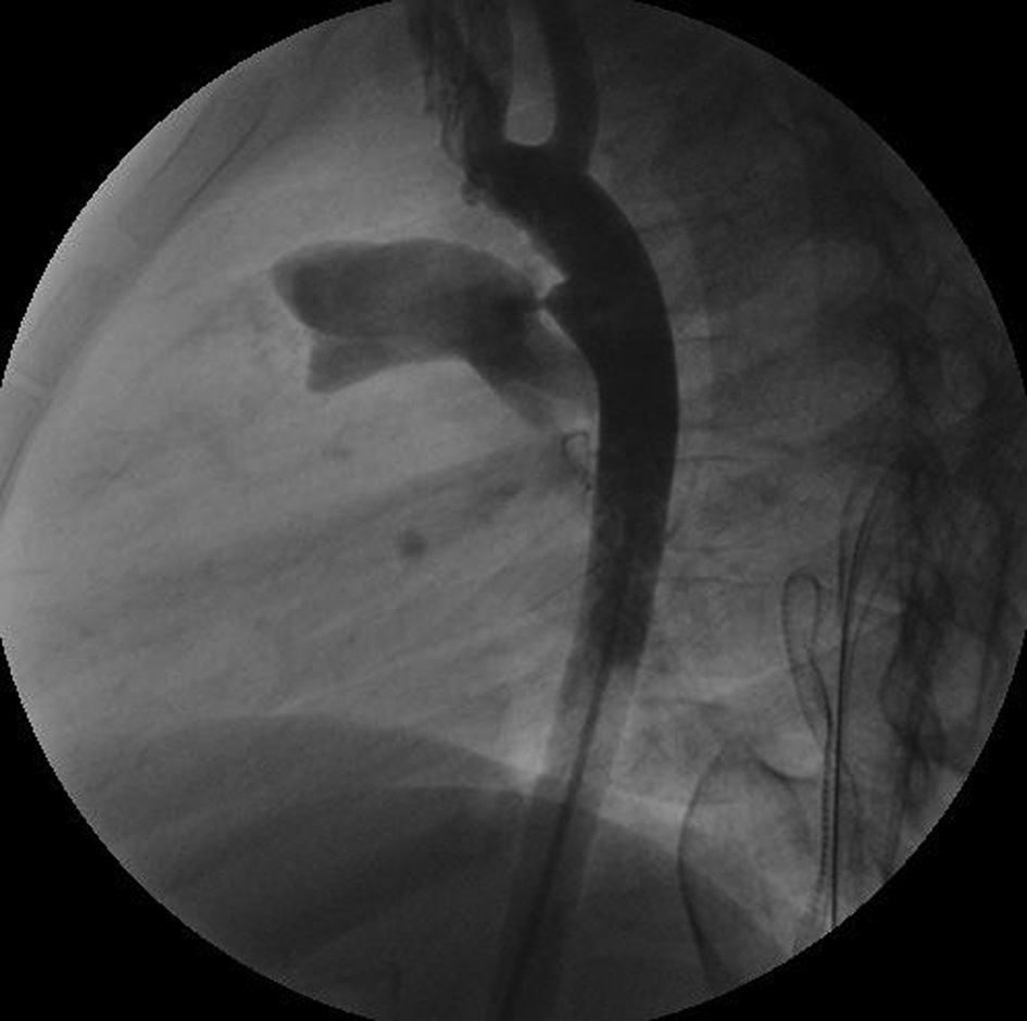 A Rare Complication of PDA Coil Occlusion: Rapidly ...