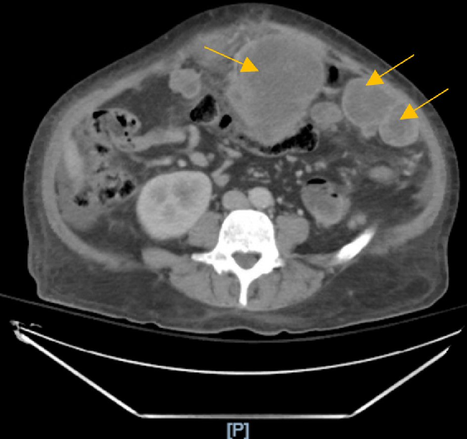 small cell carcinoma icd 10