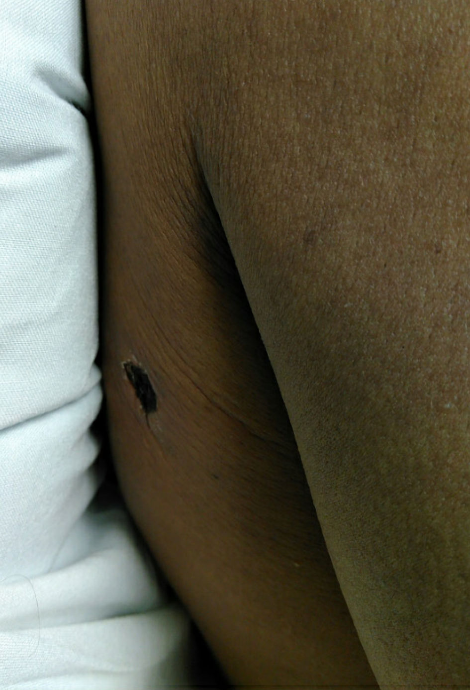 Cureus, Brown Recluse Spider Bite Resulting in Coombs Negative Hemolytic  Anemia in a Young Male Requiring Blood Transfusion
