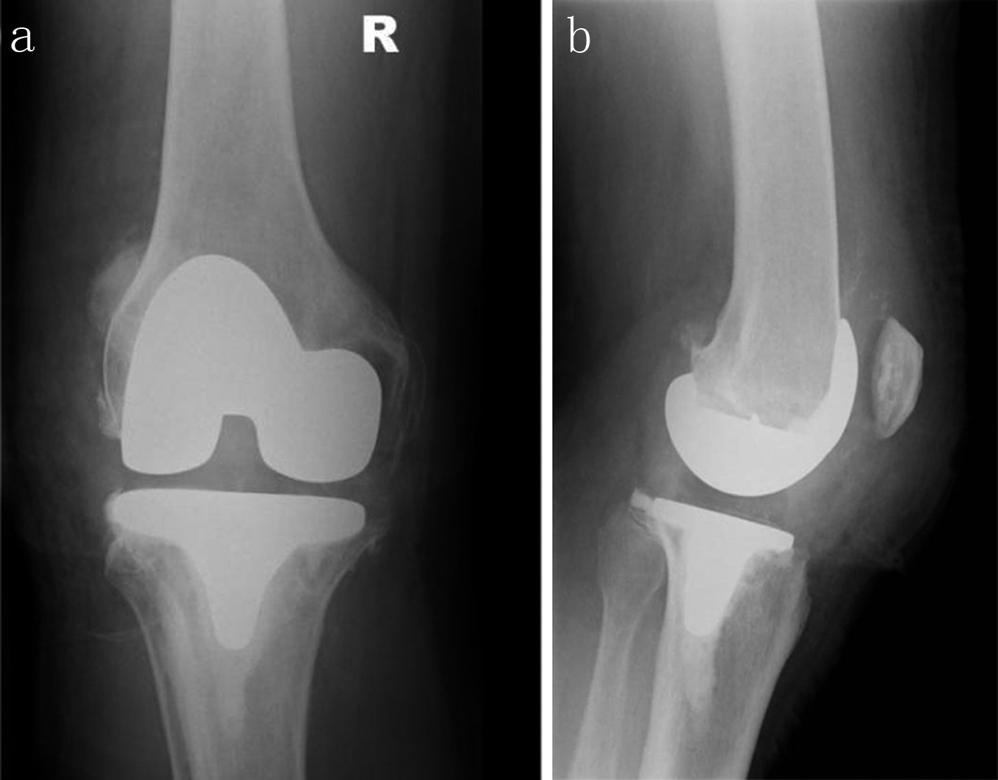 Figure 2. Right knee X-rays post-arthroplasty (AP: a, and lateral: b) .