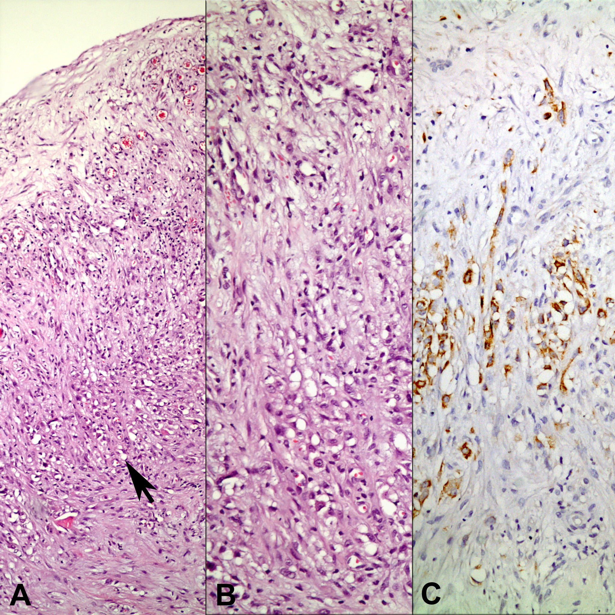 nivolumab ipilimumab mesothelioma ema