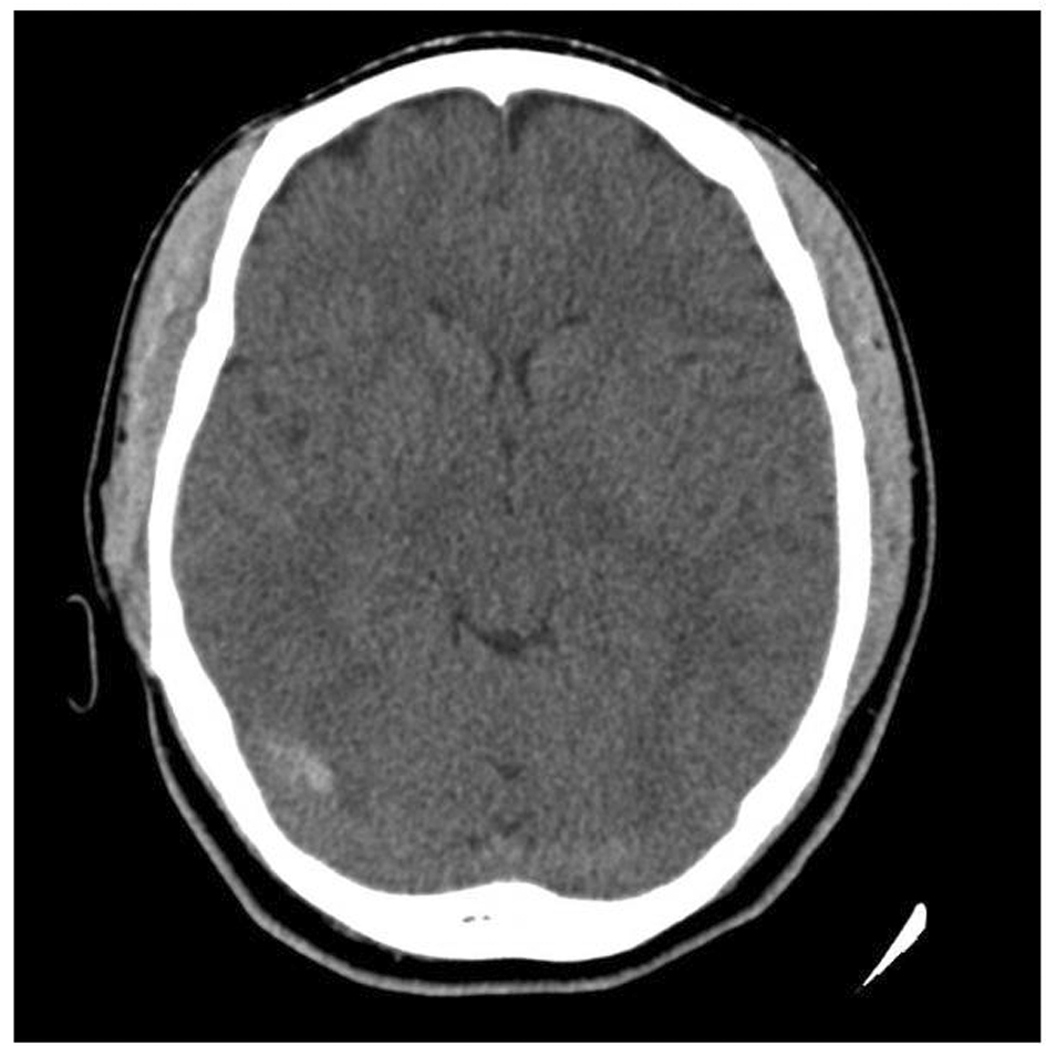 Cerebral Venous Sinus Thrombosis After Cervical Spine Epidural ...